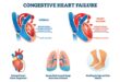 Congestive Heart Failure Patient Education