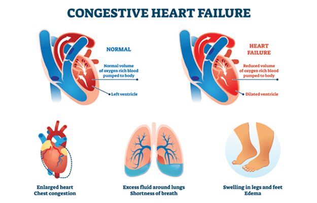 A Step Wise Guide To Congestive Heart Failure Patient Education Vermont Republic